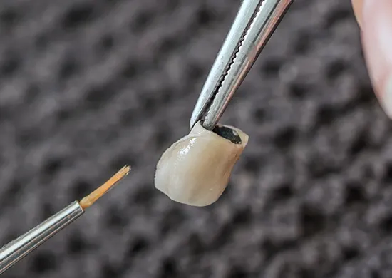 Porcelain Fused to Metal Crowns